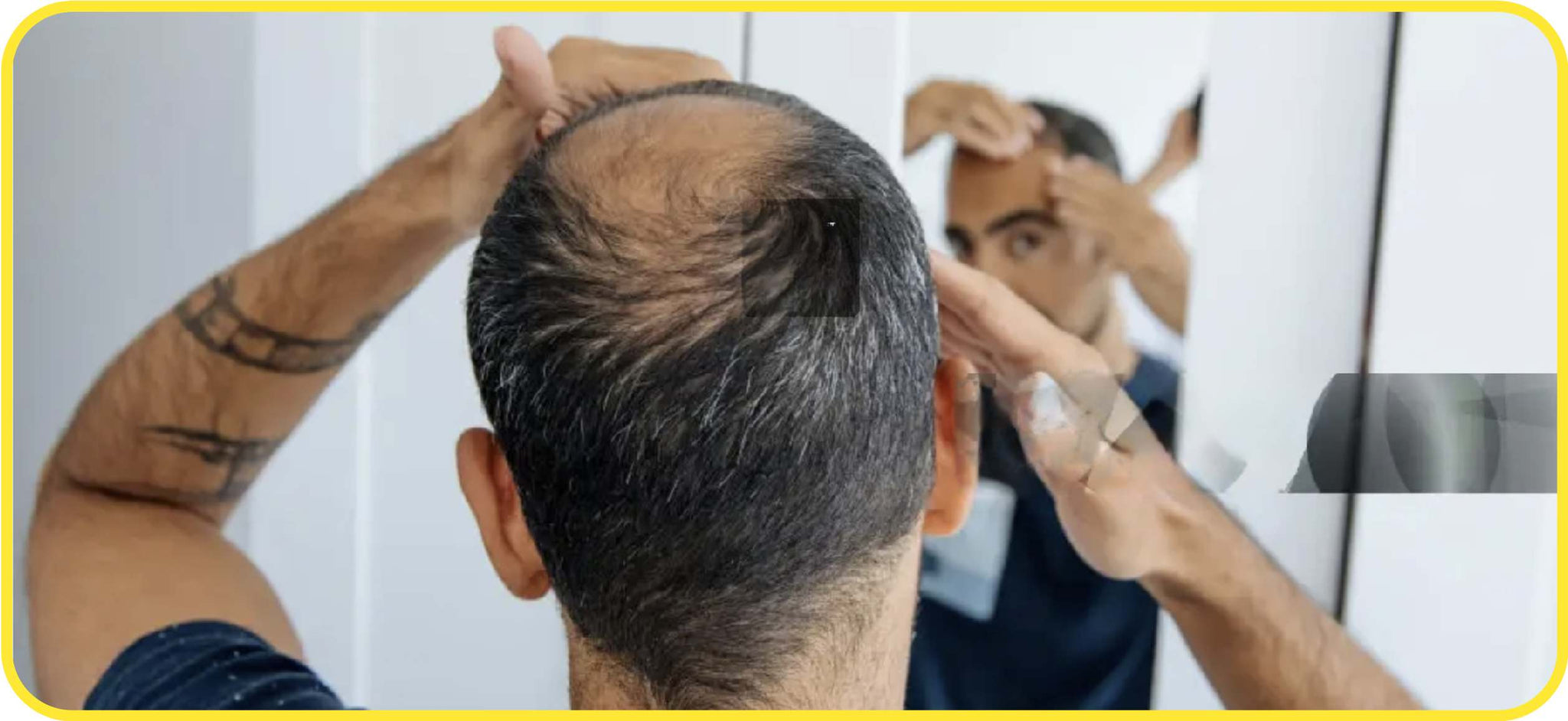 6 things to do if you’re too young to go bald!